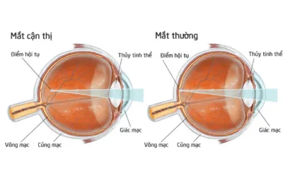 So sánh điểm khác biệt giữa mắt cận thị và mắt thường