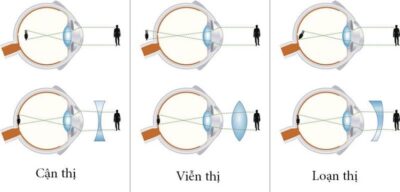 cận thị, loạn thị, viễn thị