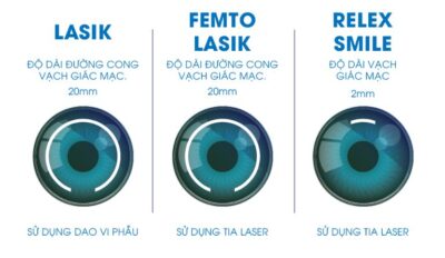 các phương pháp mổ cận thị 