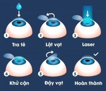 mổ cận thị lasik 