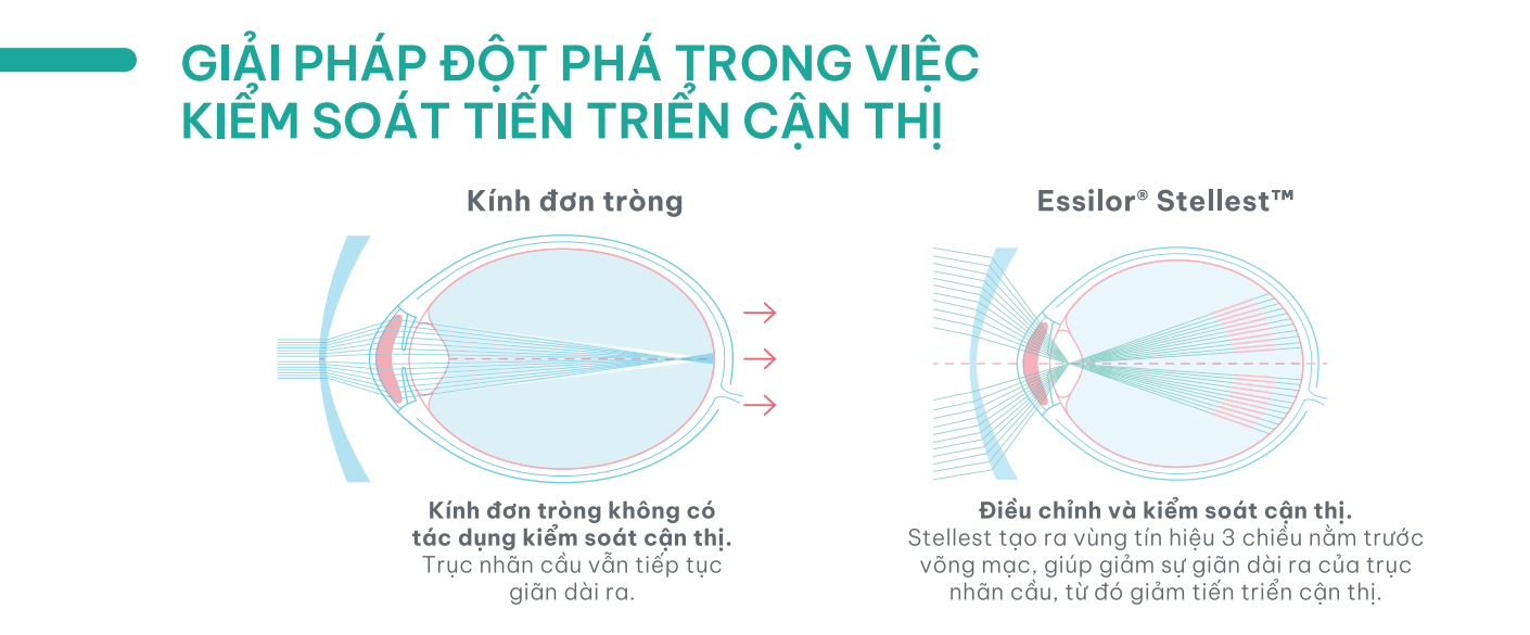giải pháp đột phá trong việc kiểm soát tiến triển cận thị khi so sánh kính đơn tròng và essilor stellest