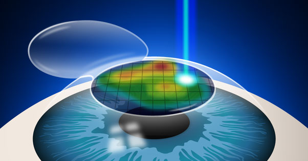 phẫu thuật Lasik