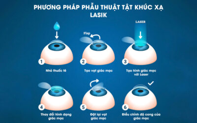 phuong phap phau thuat lasik 3