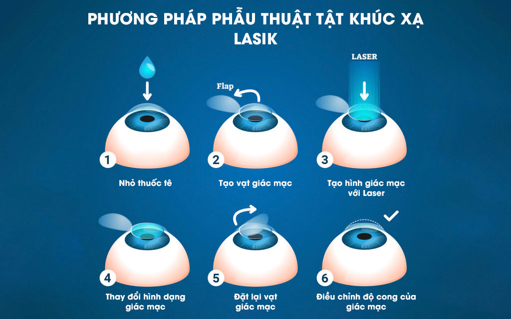 các bước phương pháp phẫu thuật tật khúc xạ lasik