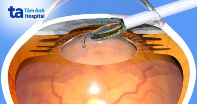 quy trinh mo phaco 3