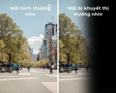 Phân biệt mắt bình thường và mắt bị khuyết thị